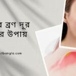 মুখের ব্রণ দূর করার উপায়